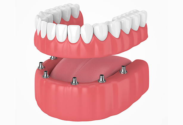 Benefits of Implant-Retained Dentures