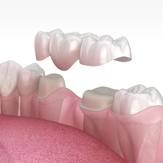 Dental Bridges in Golders Green, London