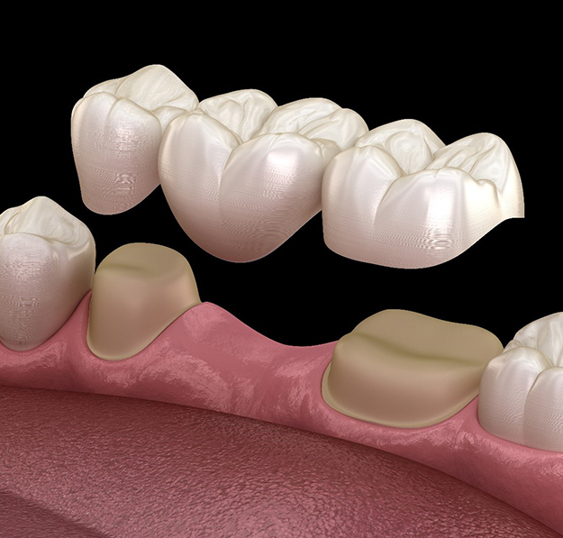 Dental Crowns and Bridges in Golders Green, London