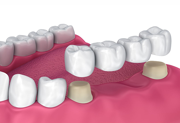 Dental Crowns And Bridges