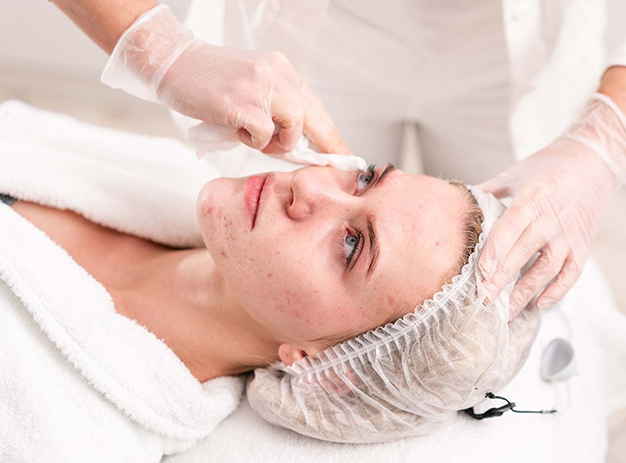 Facials for Acne and Rosacea in Golders Green, London