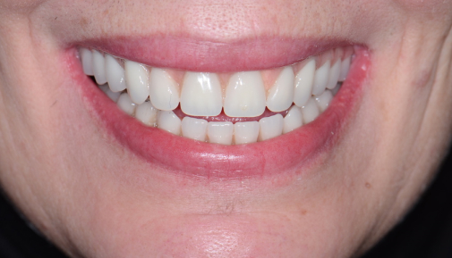 Full Mouth Teeth-in-a-Day Implants - After