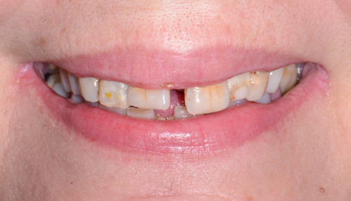 Full Mouth Teeth-in-a-Day Implants - Before