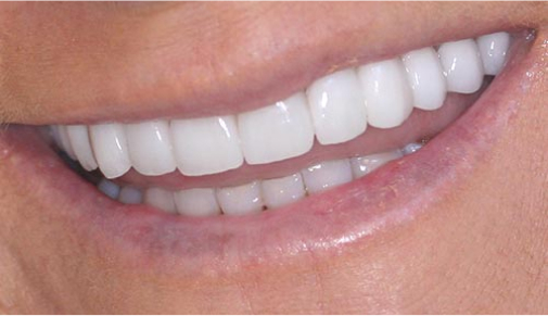 Smile Makeover with Veneers - After