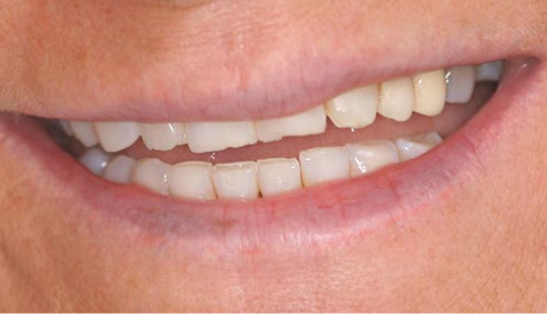 Smile Makeover with Veneers - Before