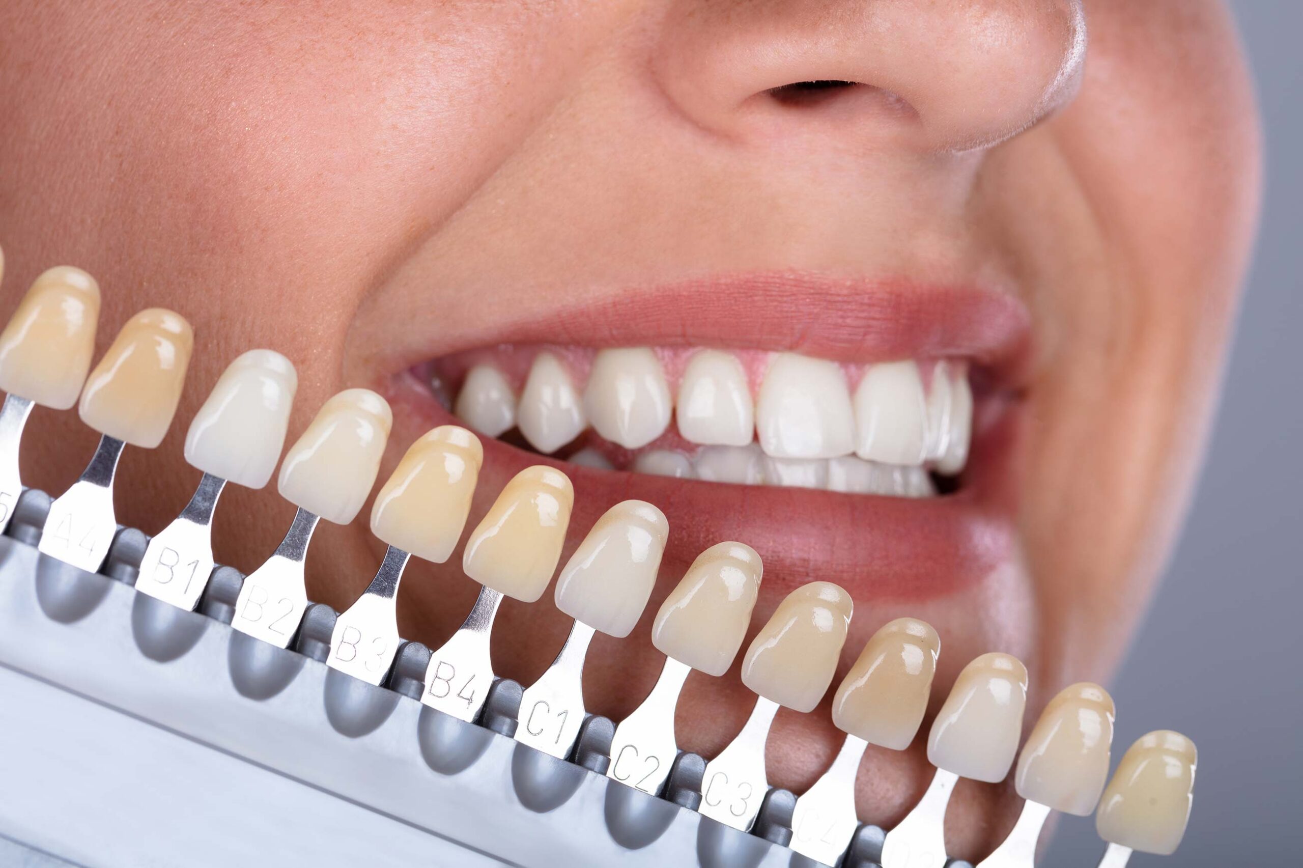 What Composite Veneers Can Fix