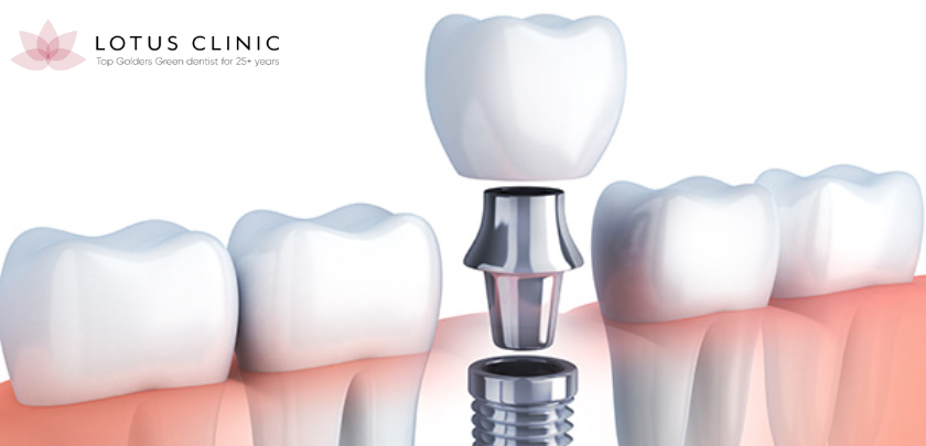 Comparing Dental Implant Options A Comprehensive Guide