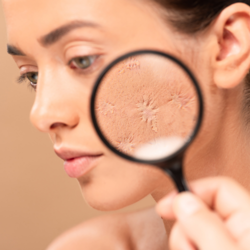 Dry Skin in Temperate Climates
