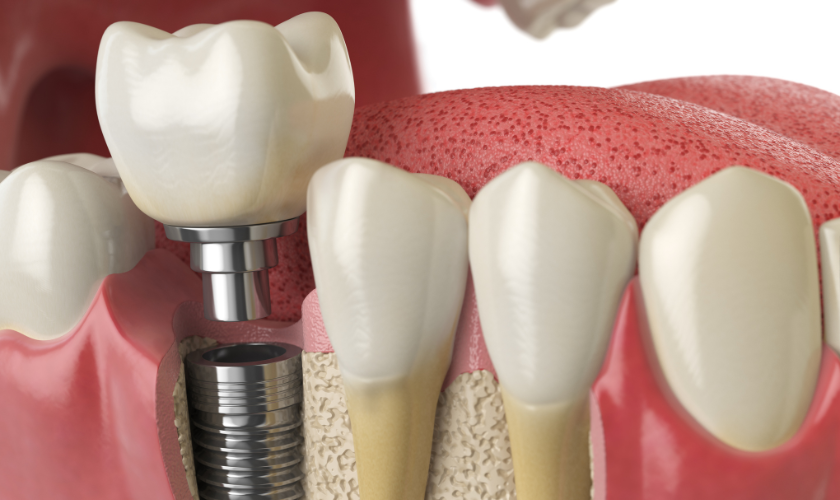 Traditional Dental Implants