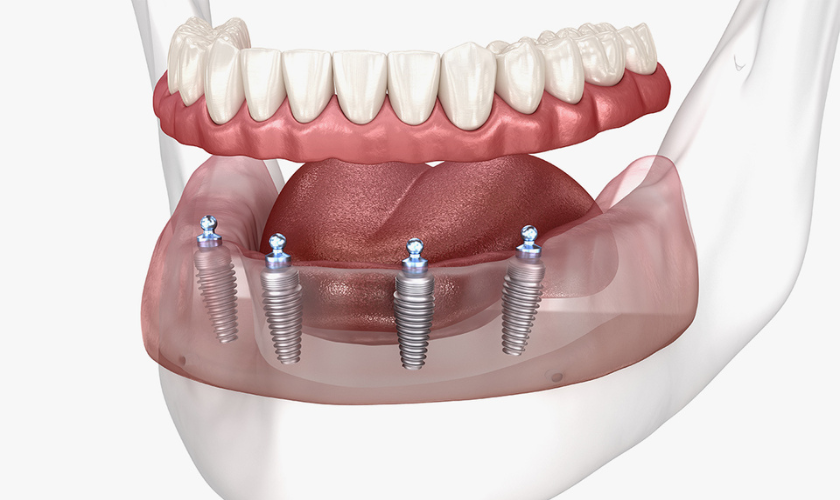 All-on-4 Implants