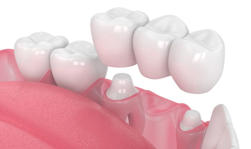 Dental Bridges
