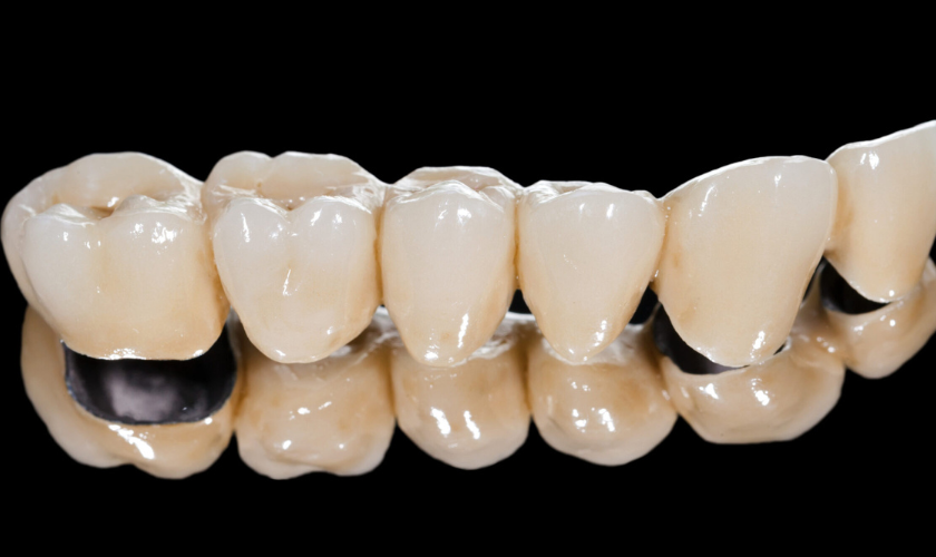 Resin-Bonded Bridges