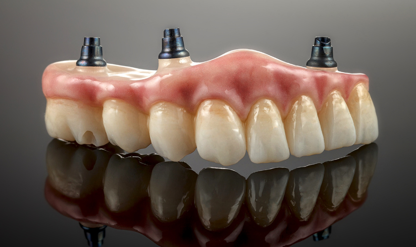 Snap-in Dentures