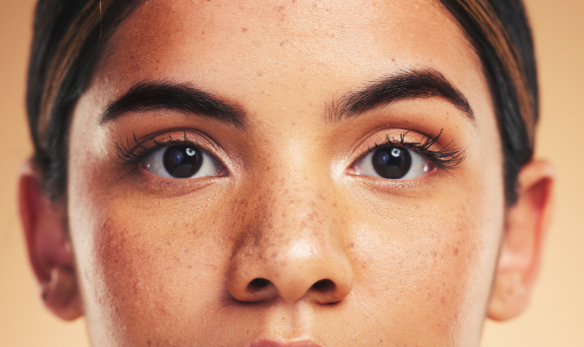 Types of Pigmentation