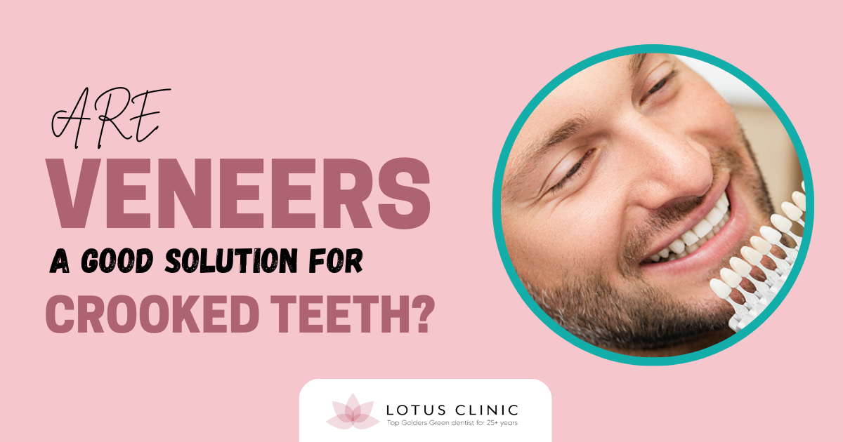 Are Veneers a Good Solution for Crooked Teeth