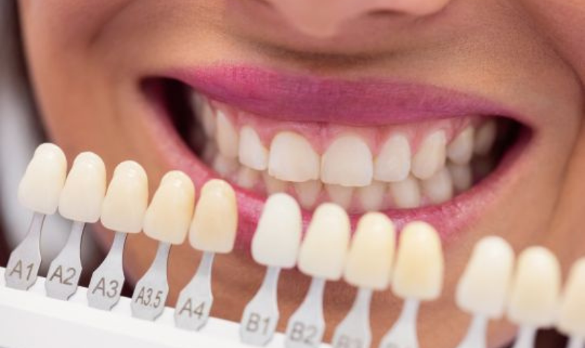 What Are Dental Veneers