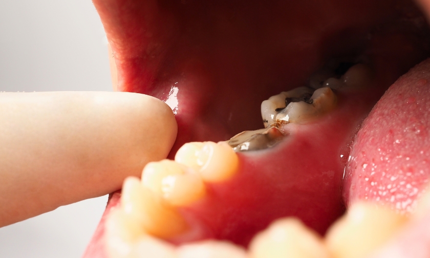 do you need fillings before root canals